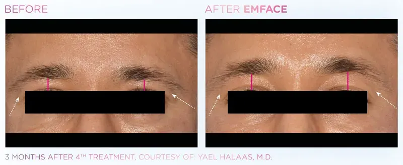 Emface before and after