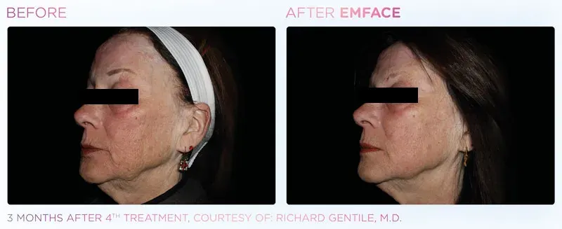 Emface before and after