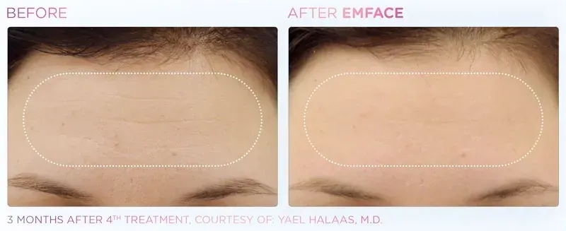 Emface before and after