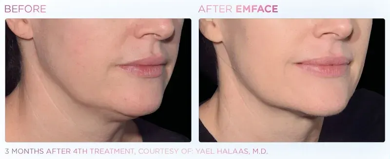 Emface before and after