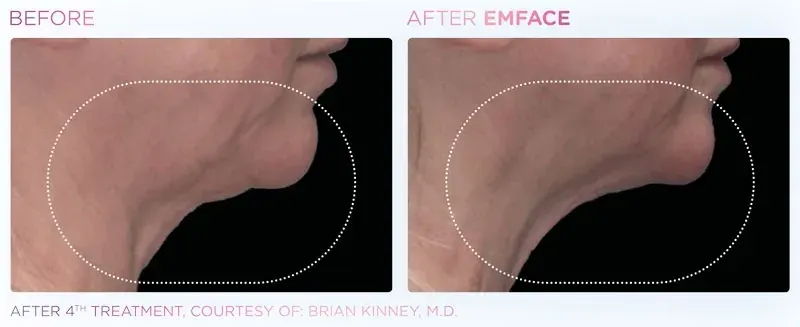 Emface before and after