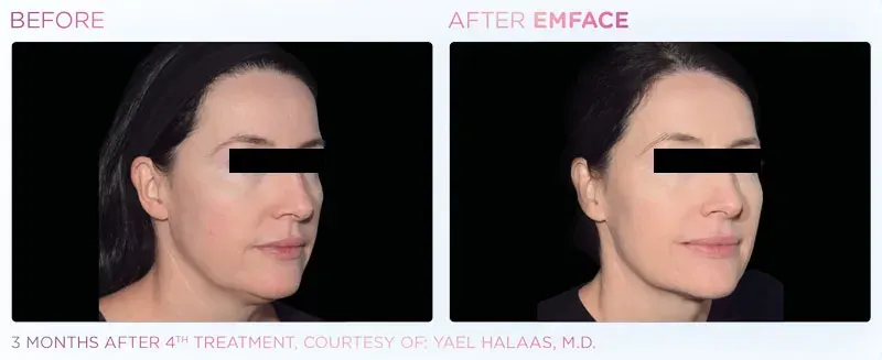 Emface before and after