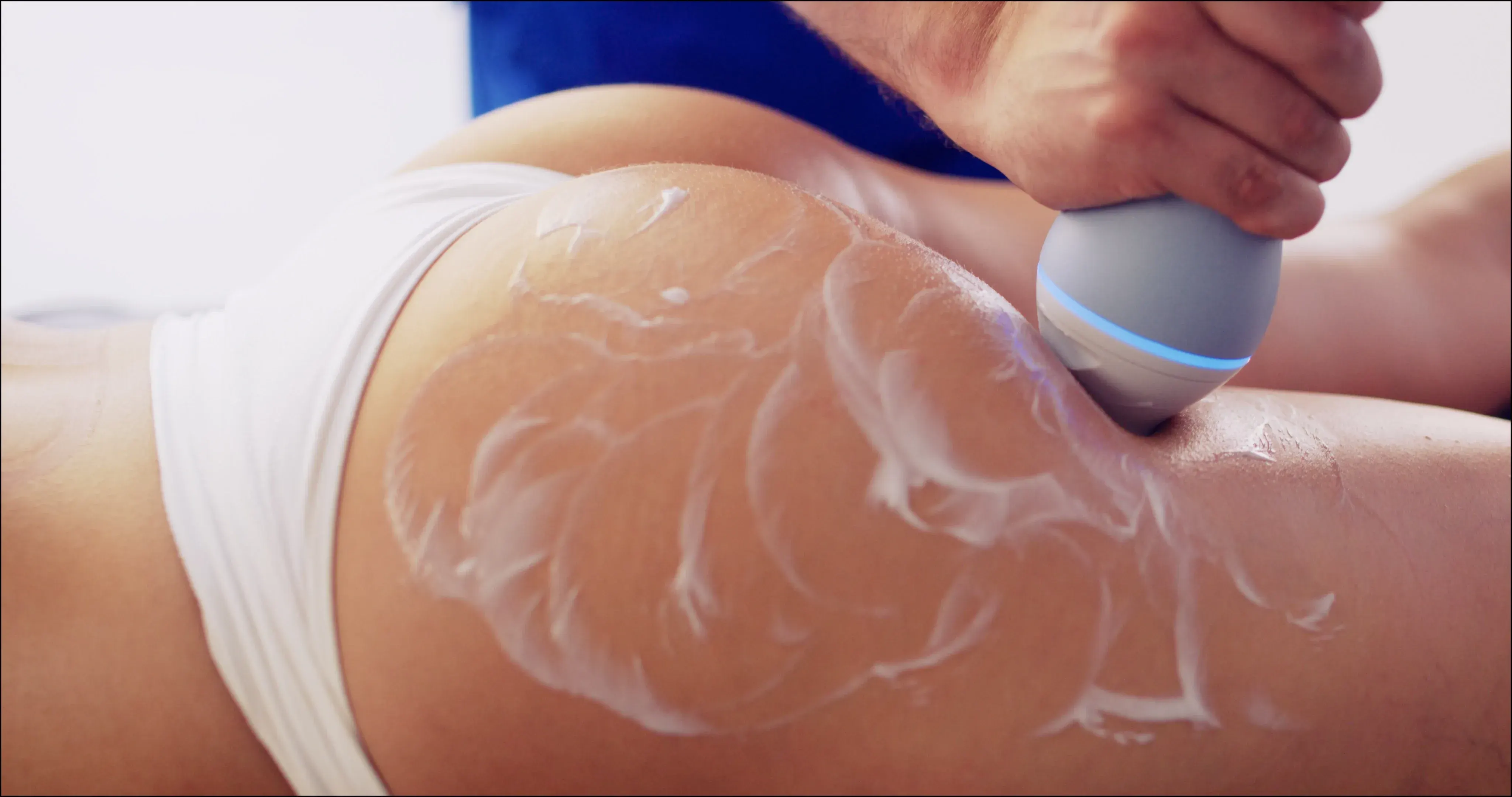 EMTONE cellulite treatment on the thighs at Chandra Wellness Center in Ocala, Florida