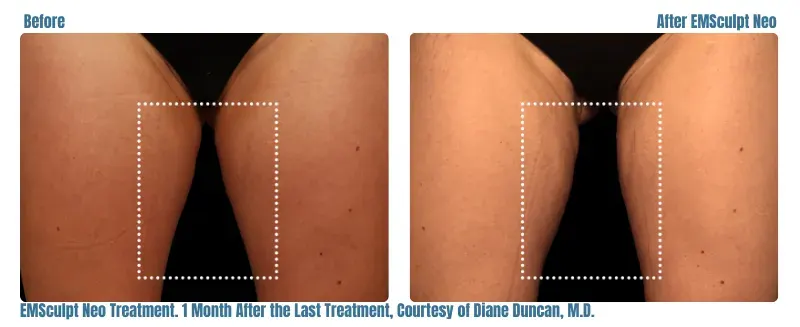 Emsculpt Neo before and after