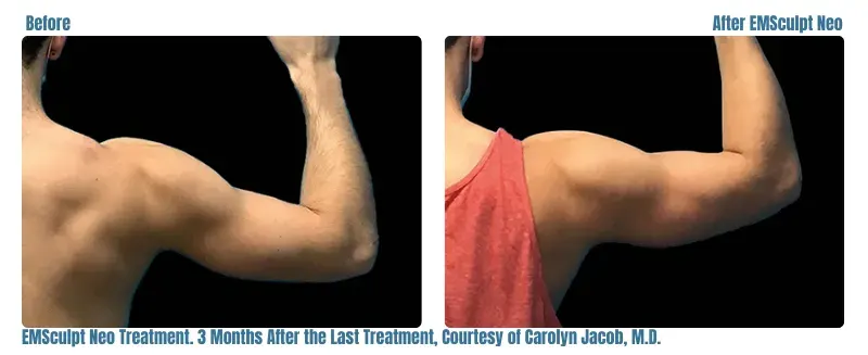 Emsculpt Neo before and after