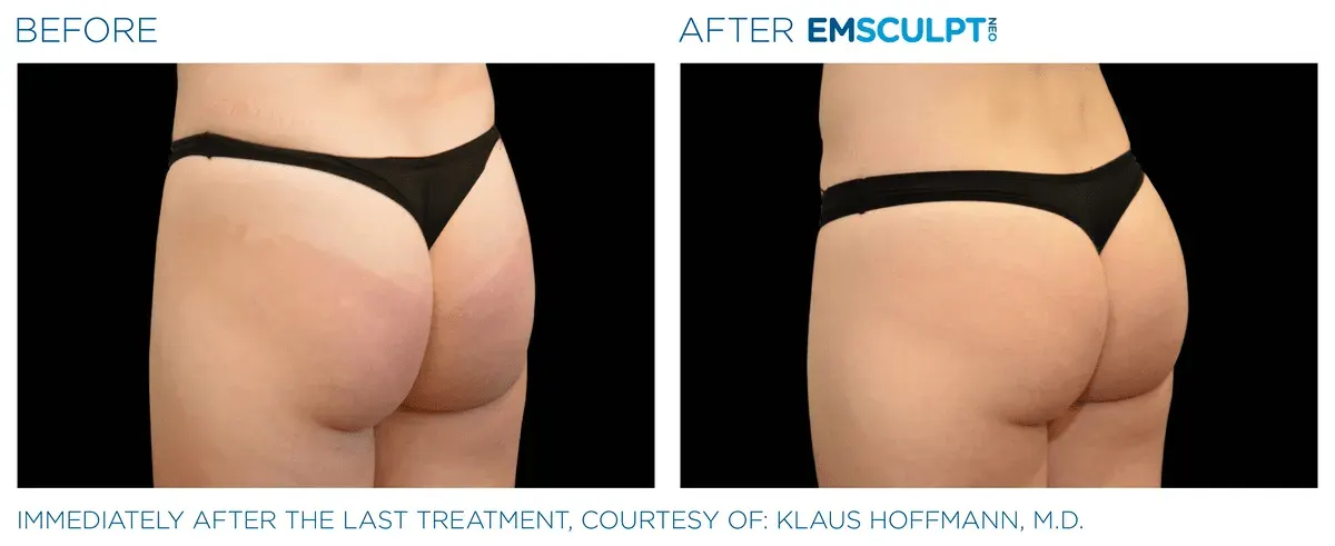 Emsculpt Neo before and after
