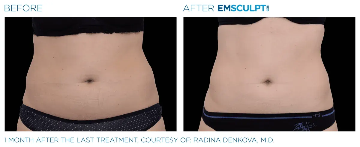 Emsculpt Neo before and after