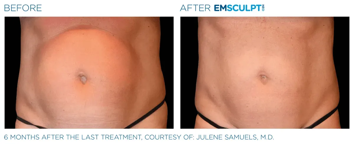 Emsculpt Neo before and after
