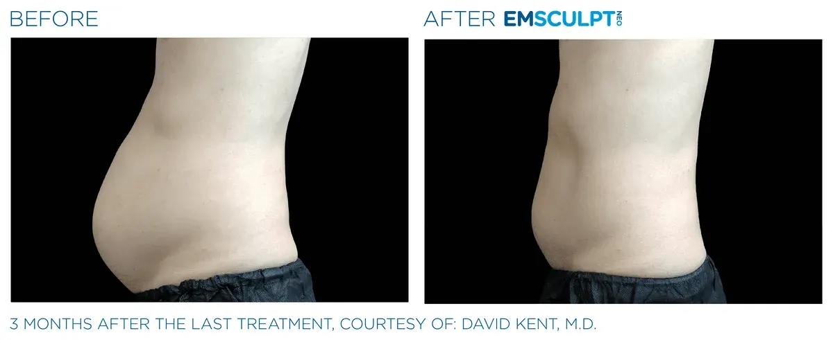 Emsculpt Neo before and after