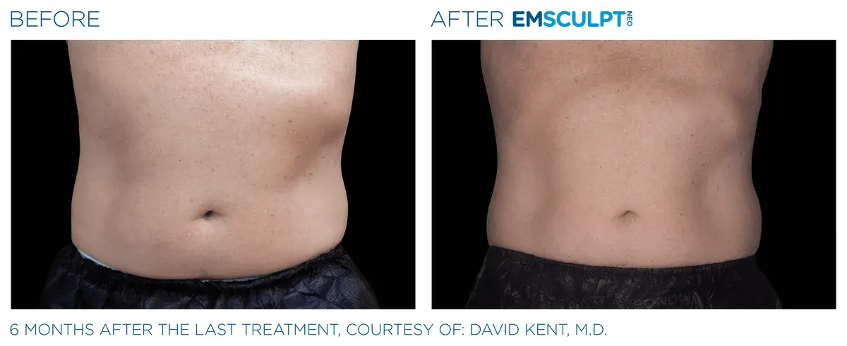 Emsculpt Neo before and after