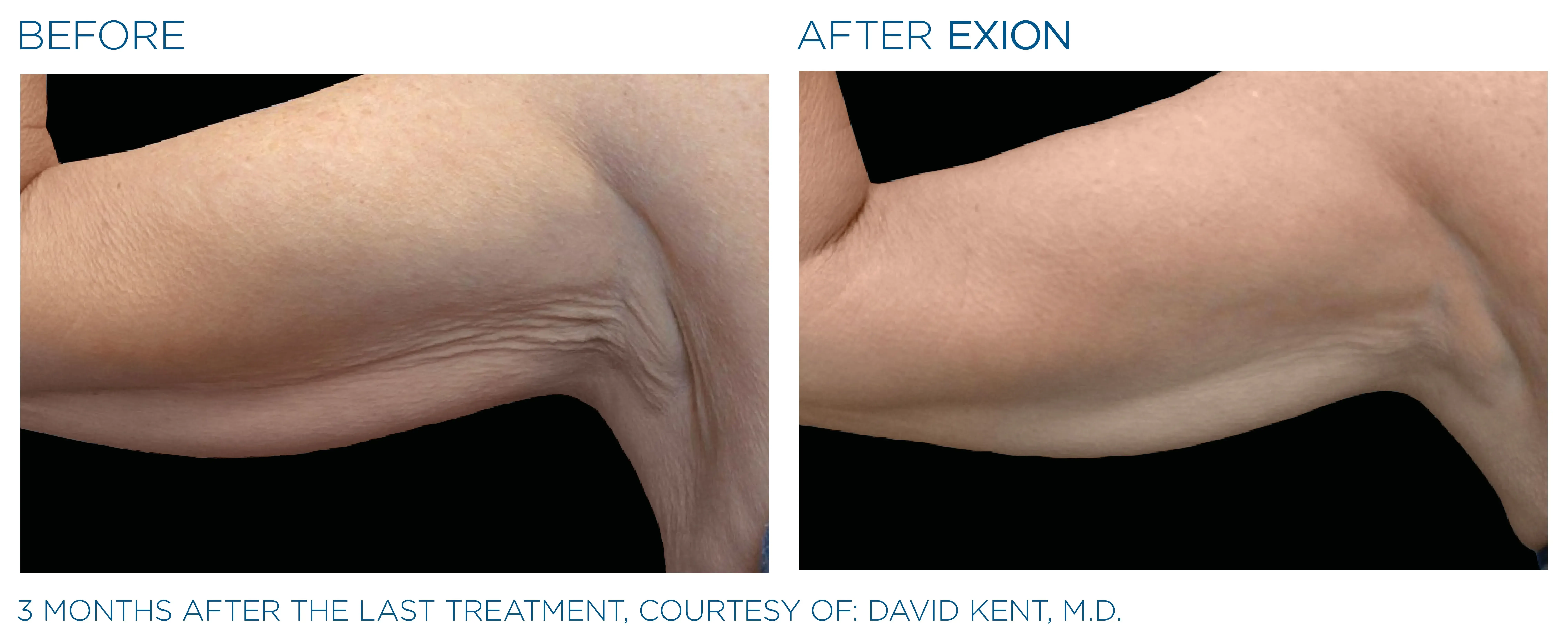 Exion before and after