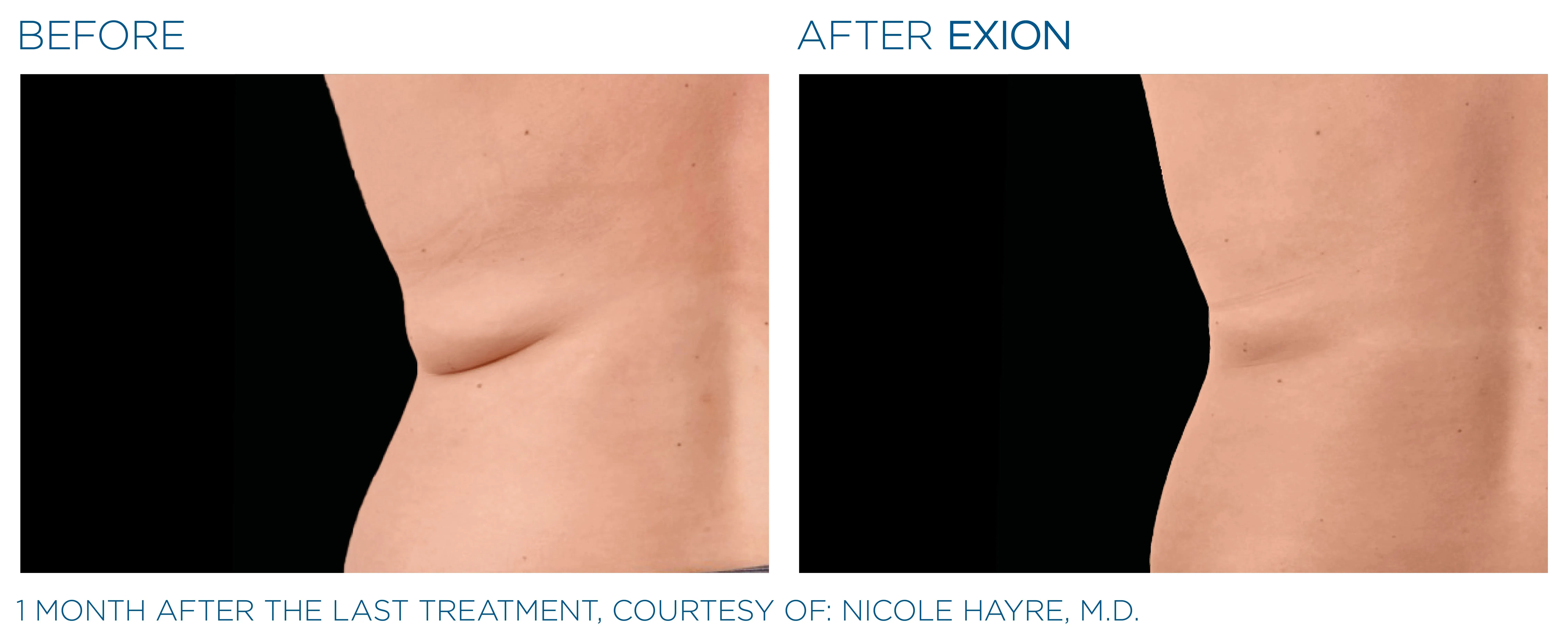 Exion before and after