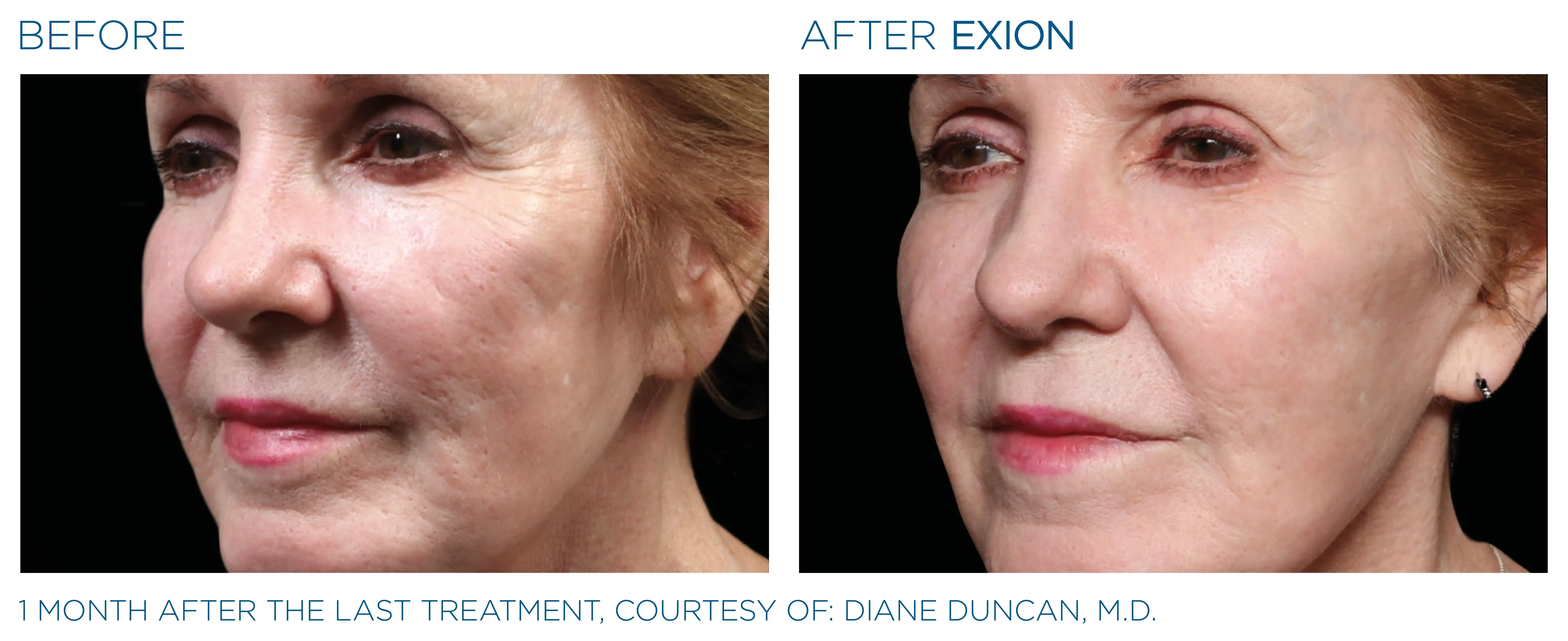 Exion before and after