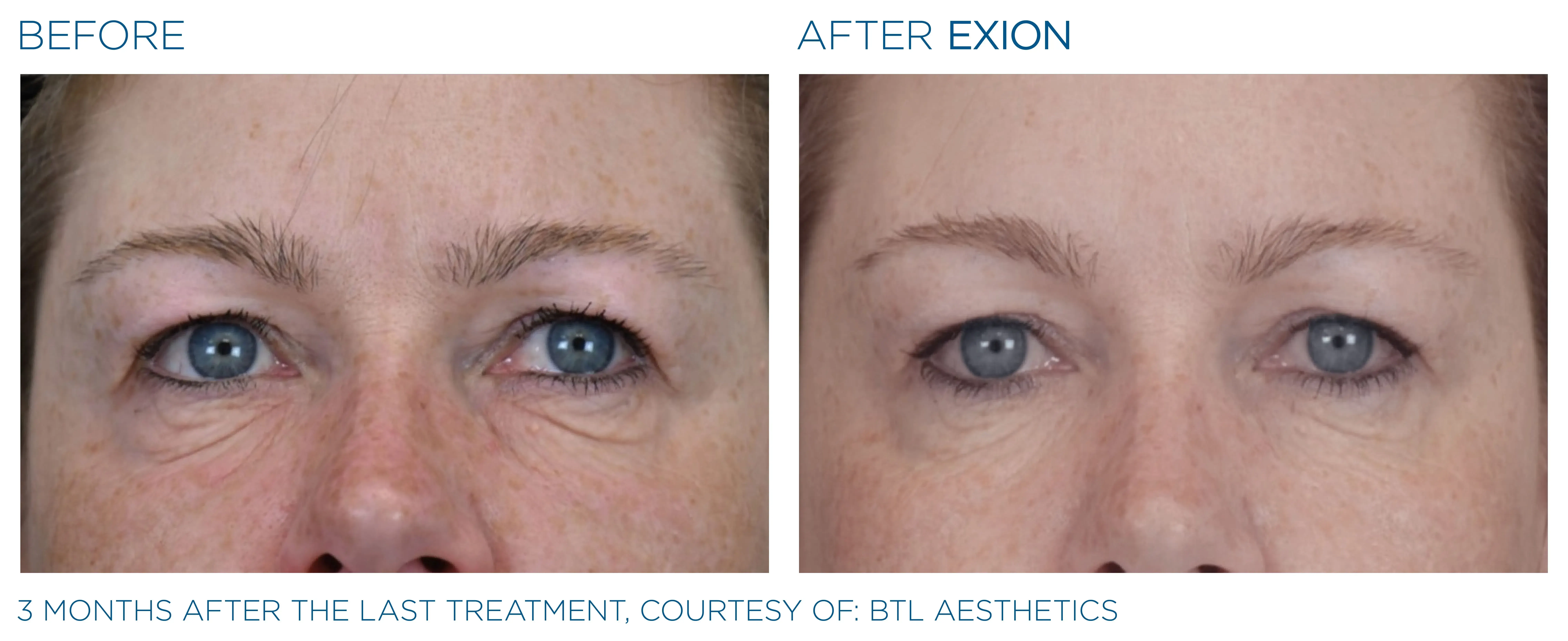 Exion before and after