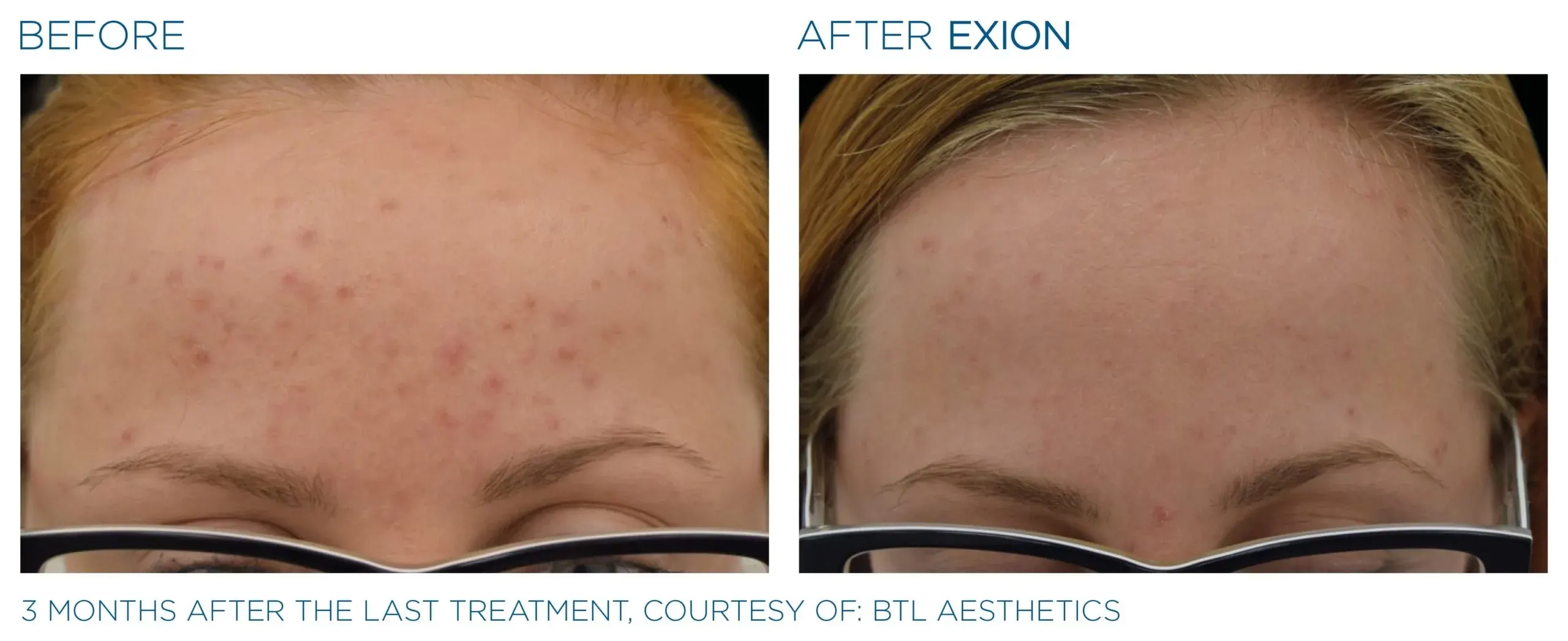 Exion before and after