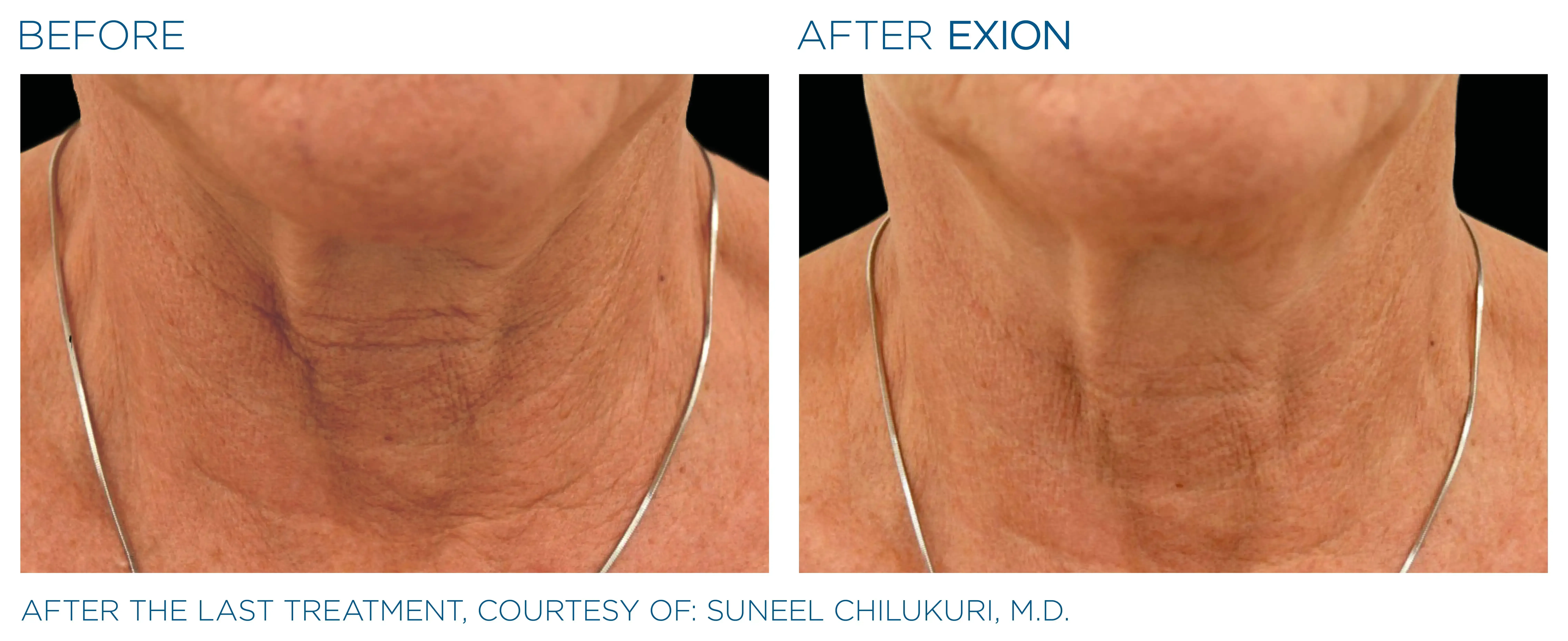 Exion before and after