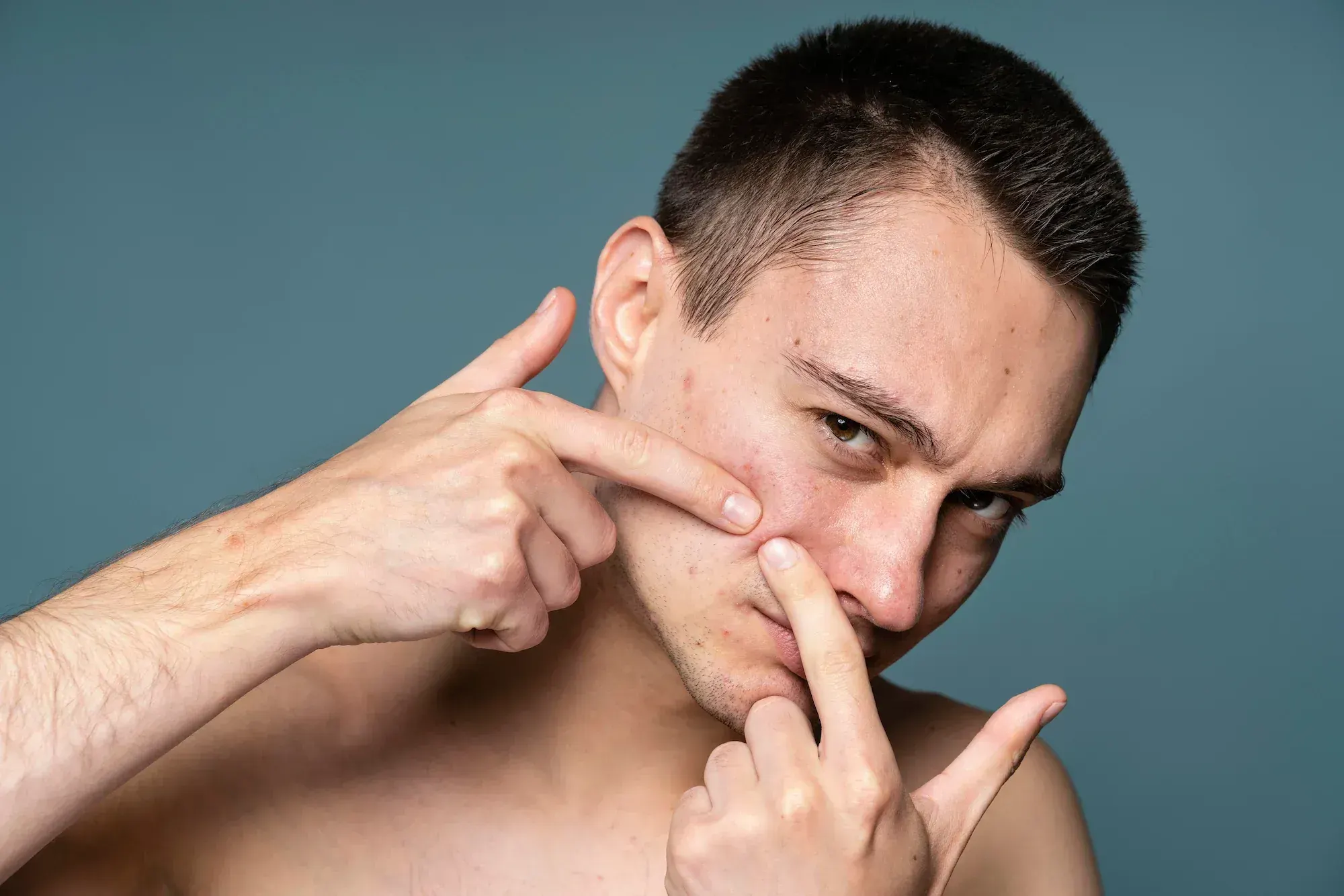 EXION RF microneedling treatment for acne scars at Chandra Wellness Center in Ocala, FL