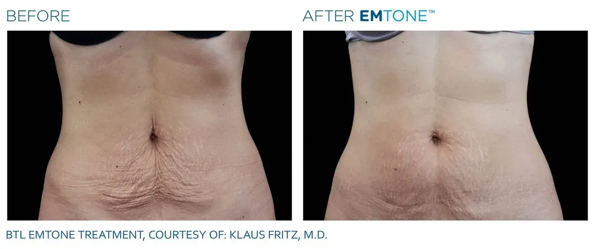 Emtone before and after