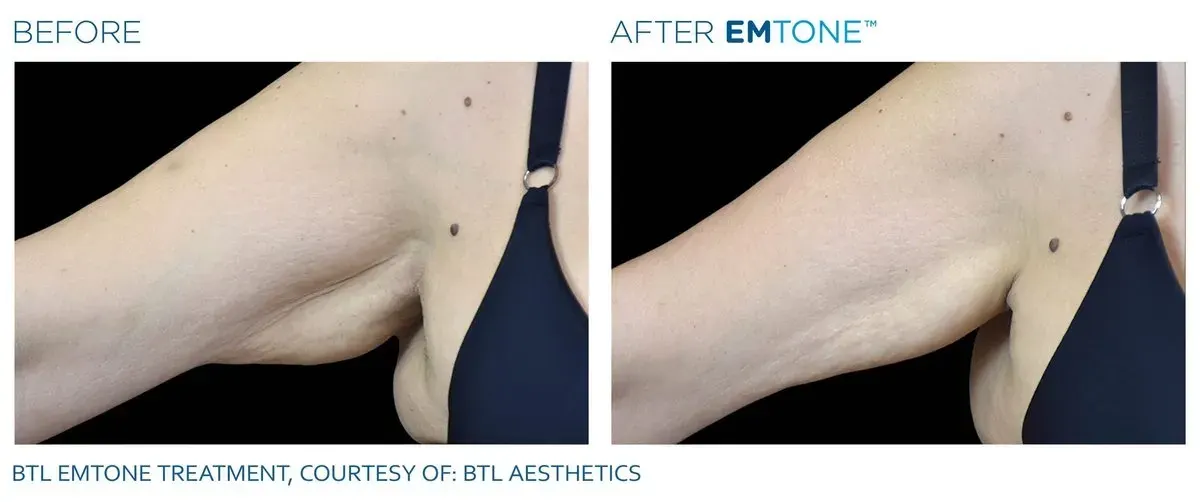 Emtone before and after