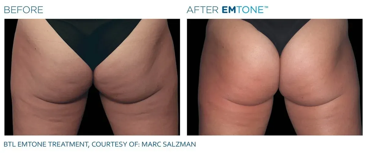 Emtone before and after