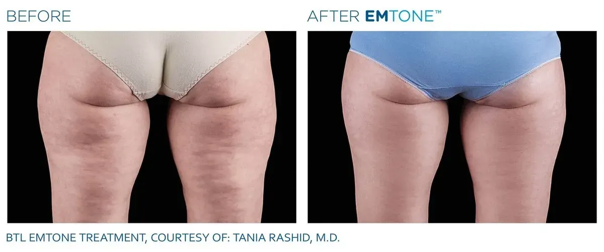 Emtone before and after