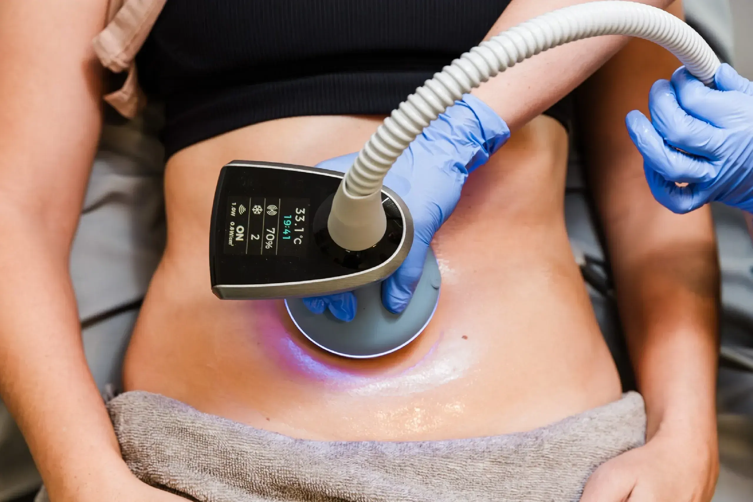 Before and after body skin tightening results showing firmer abdomen skin in Ocala, FL