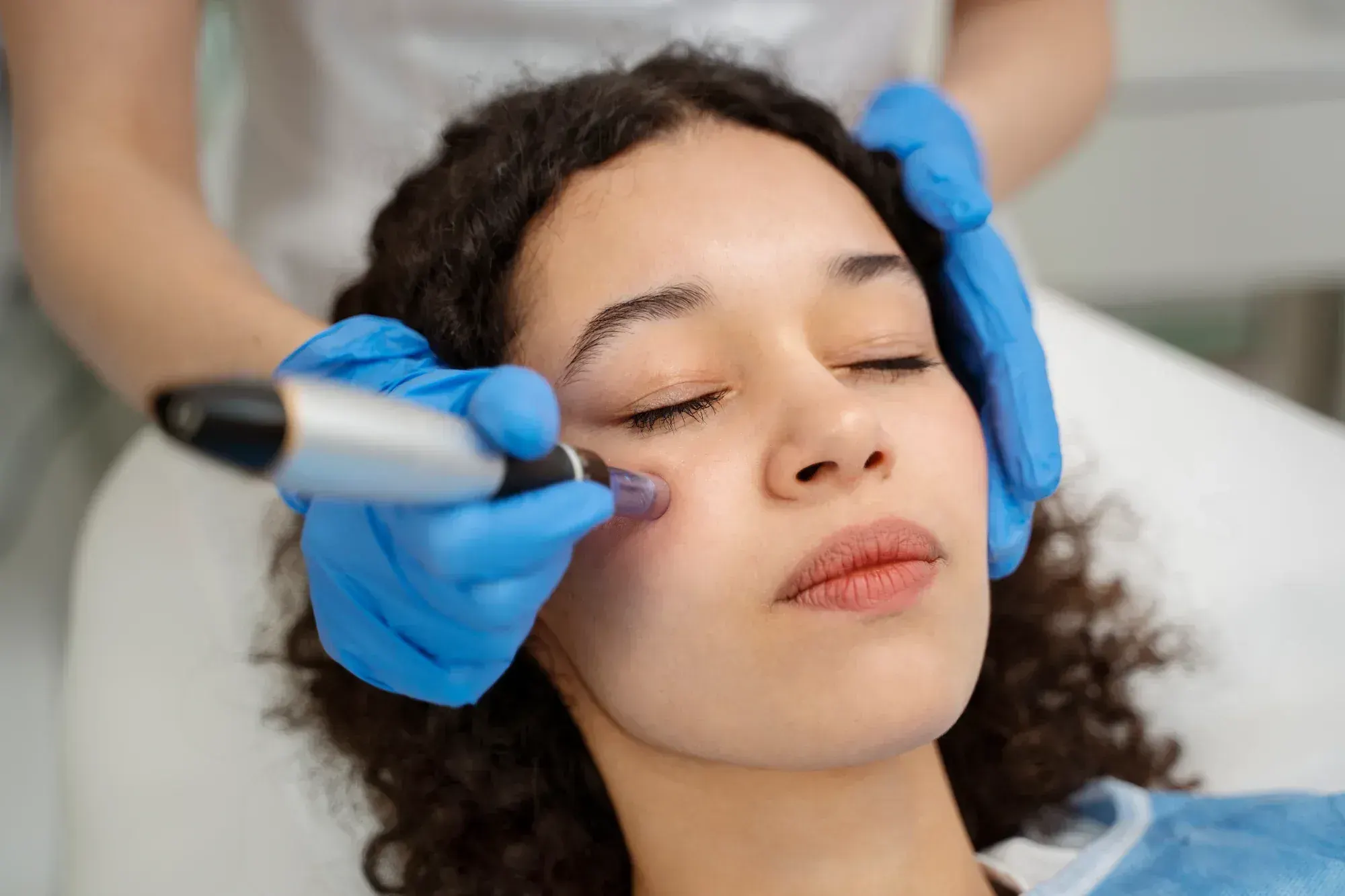 EXION RF microneedling treatment compared with traditional microneedling in Ocala, Florida