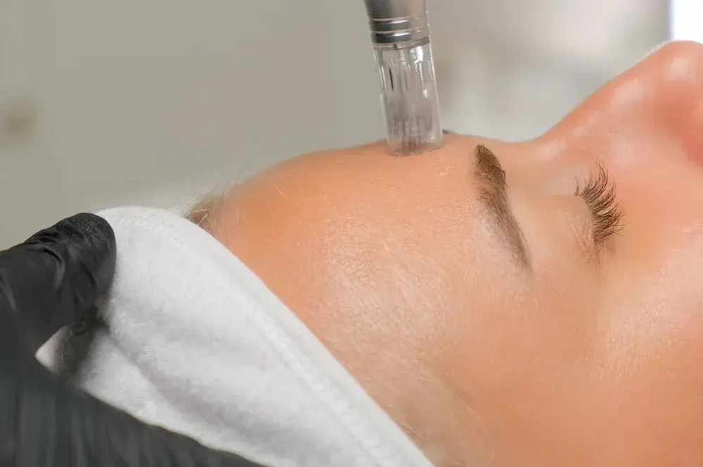 Microneedling collagen induction therapy treatment at Chandra Wellness in Ocala, Florida